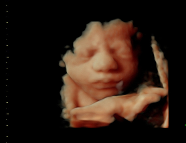 3D ultrasound image at 31 weeks